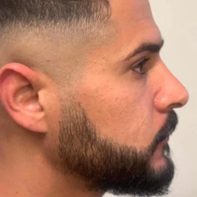 Hair transplant before and after — case 7
