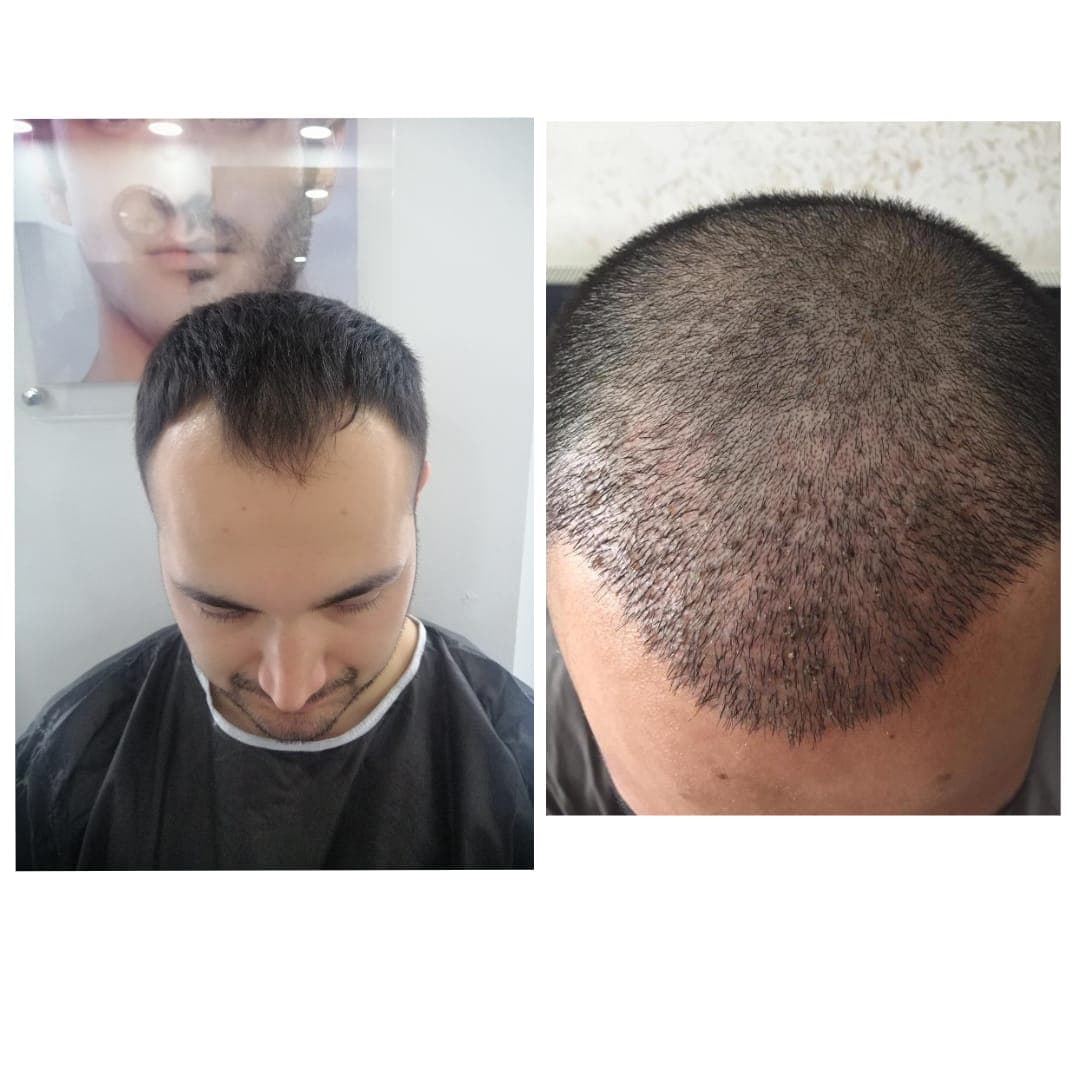 Hair transplant before and after — case 8