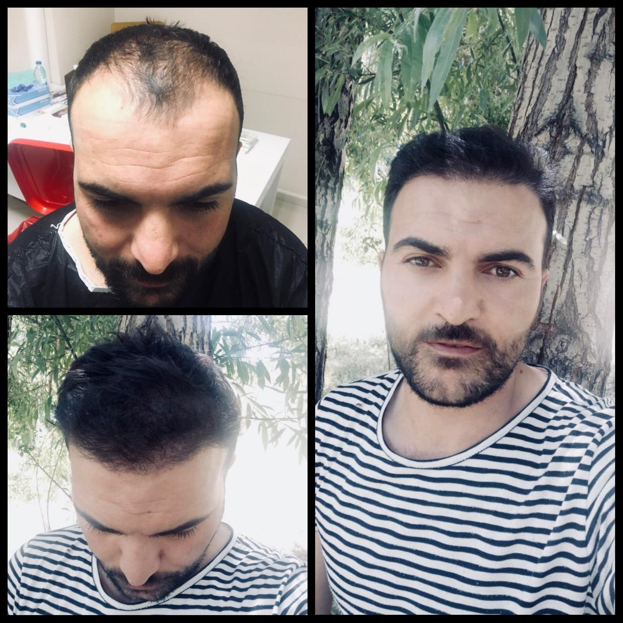 Hair transplant before and after — case 9
