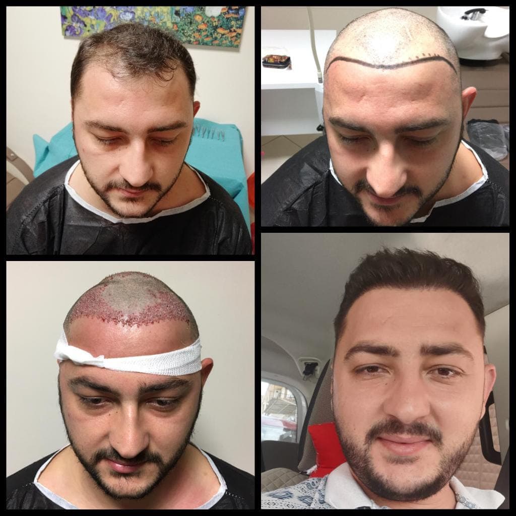 Hair transplant before and after — case 10