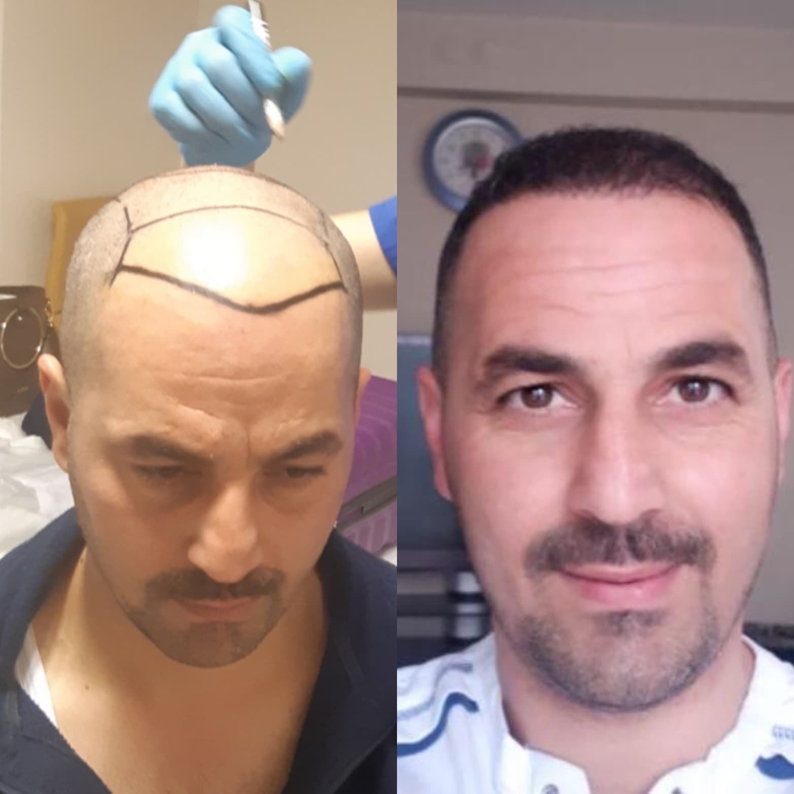Hair transplant before and after — case 11