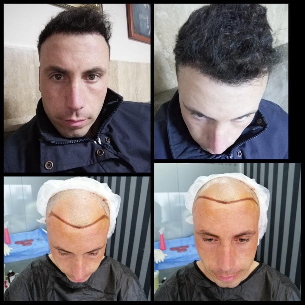 Hair transplant before and after — case 12