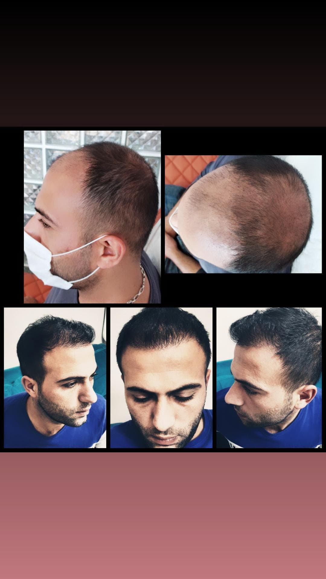 Hair transplant before and after — case 13