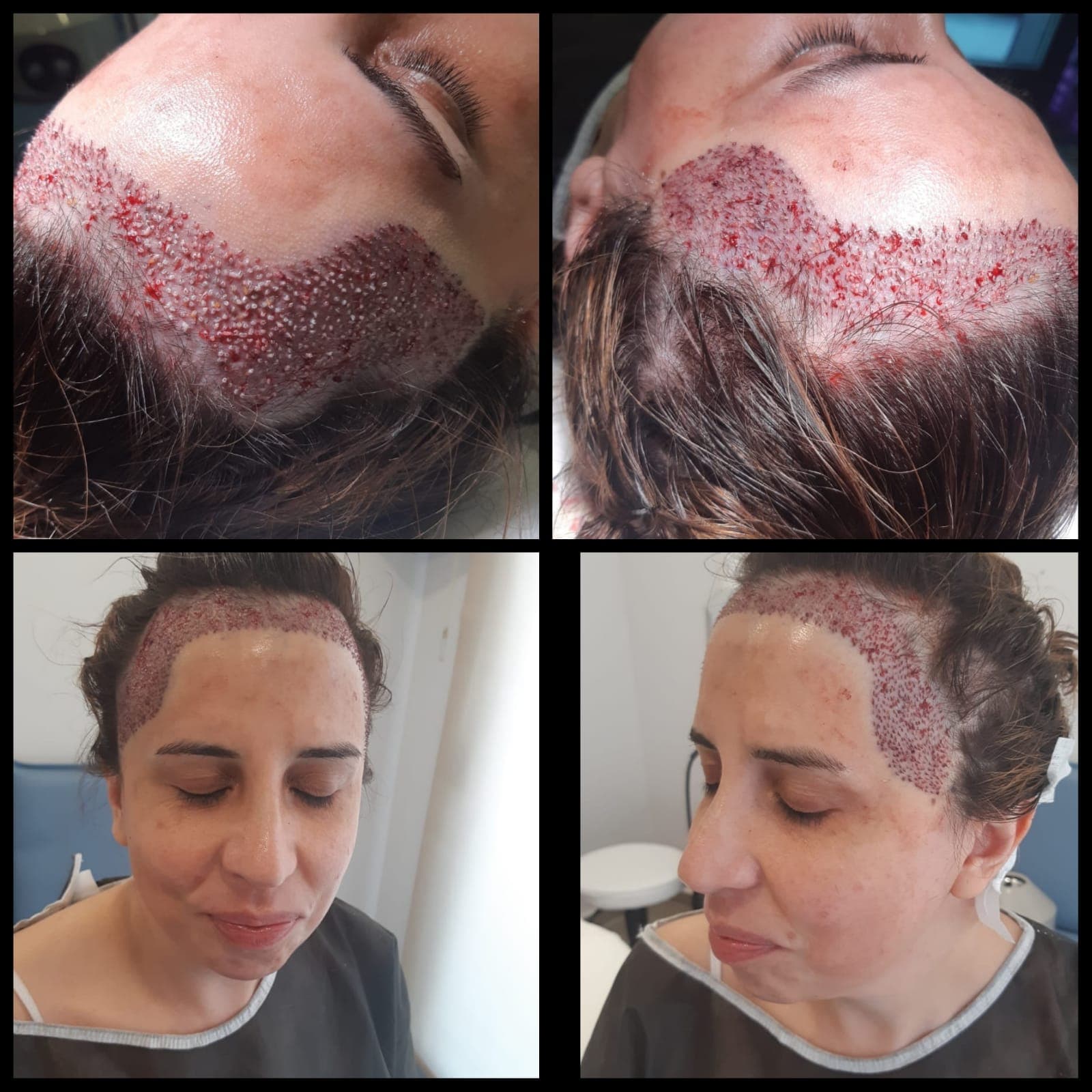 Hair transplant before and after — case 14