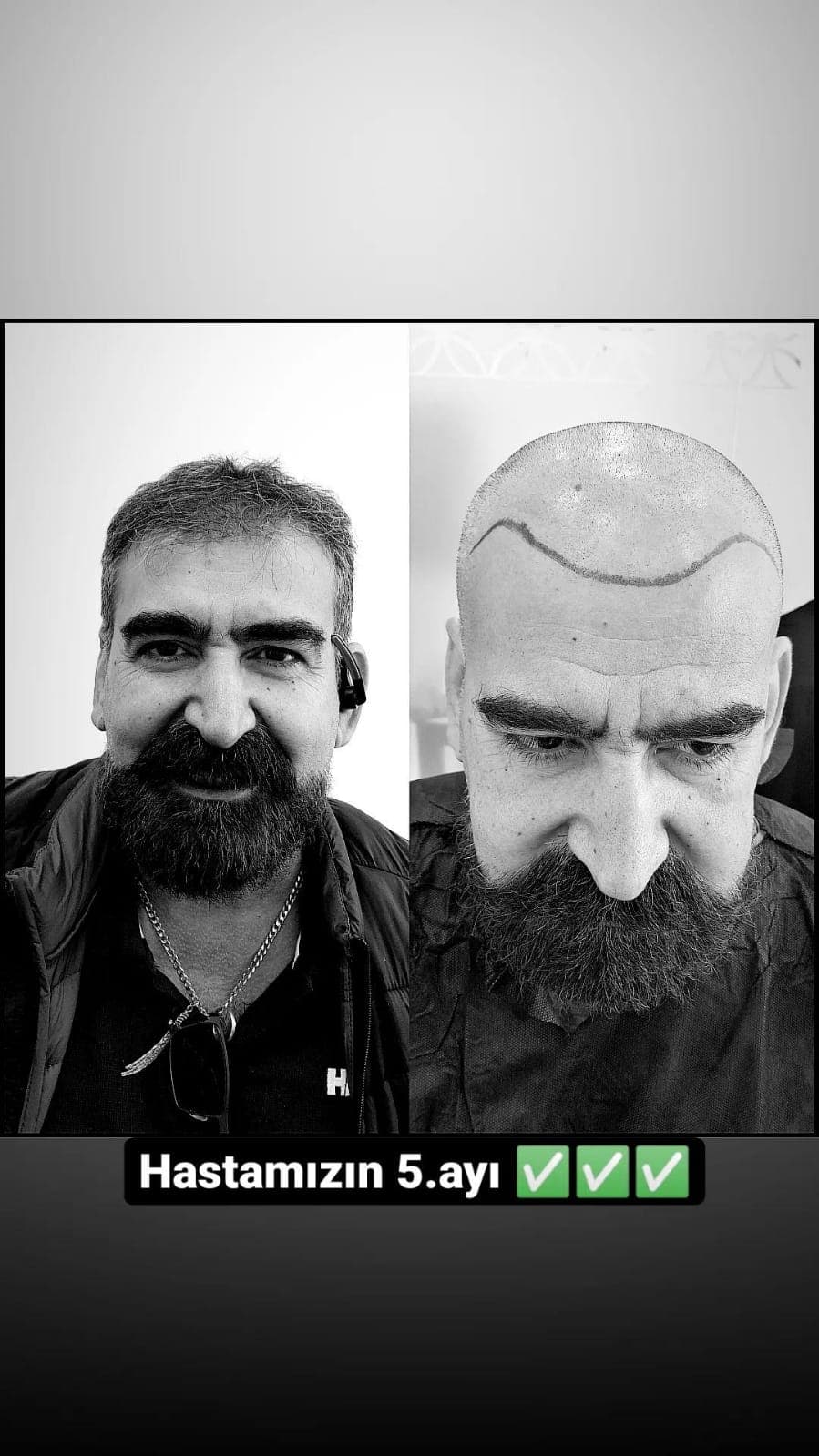 Hair transplant before and after — case 16