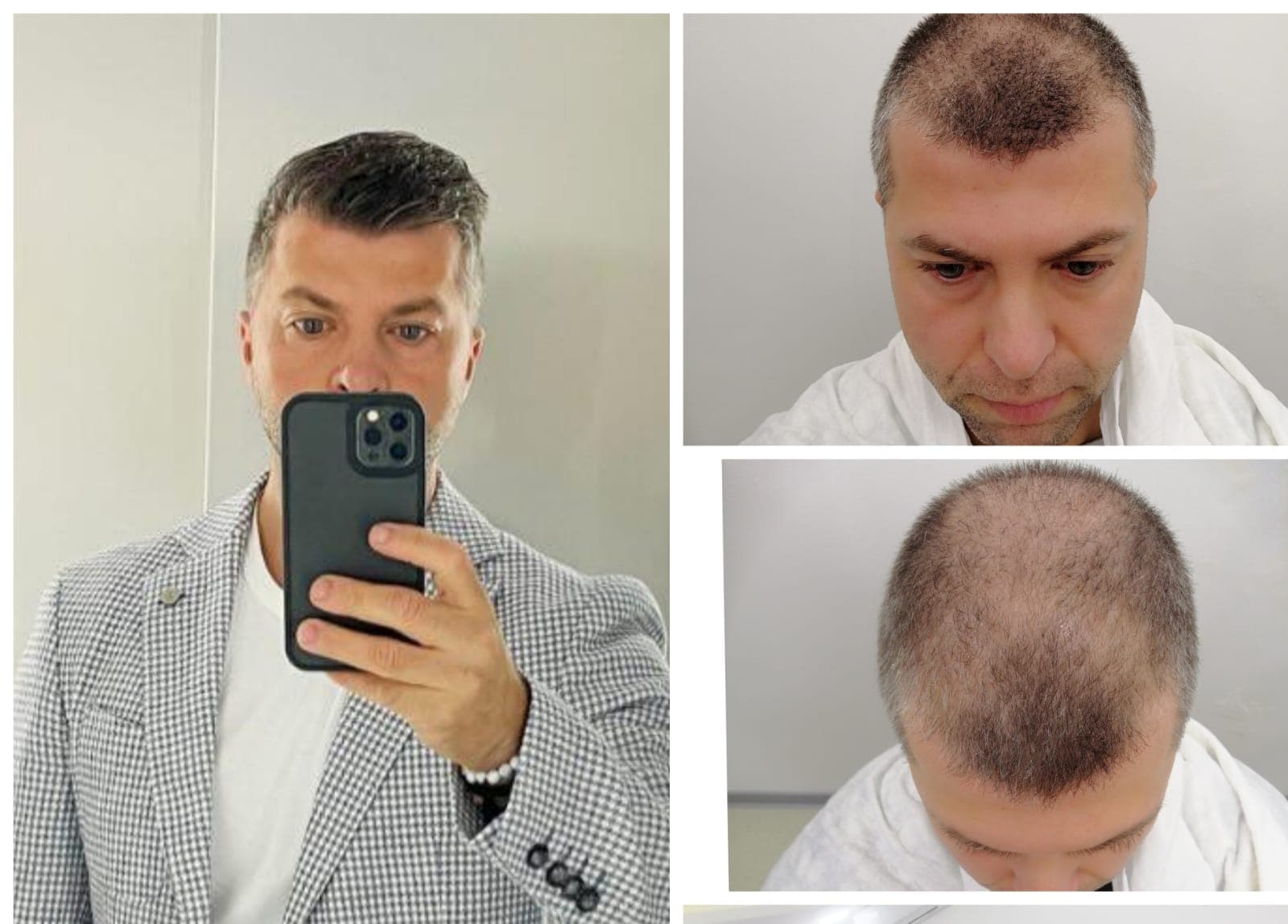 Hair transplant before and after — case 17