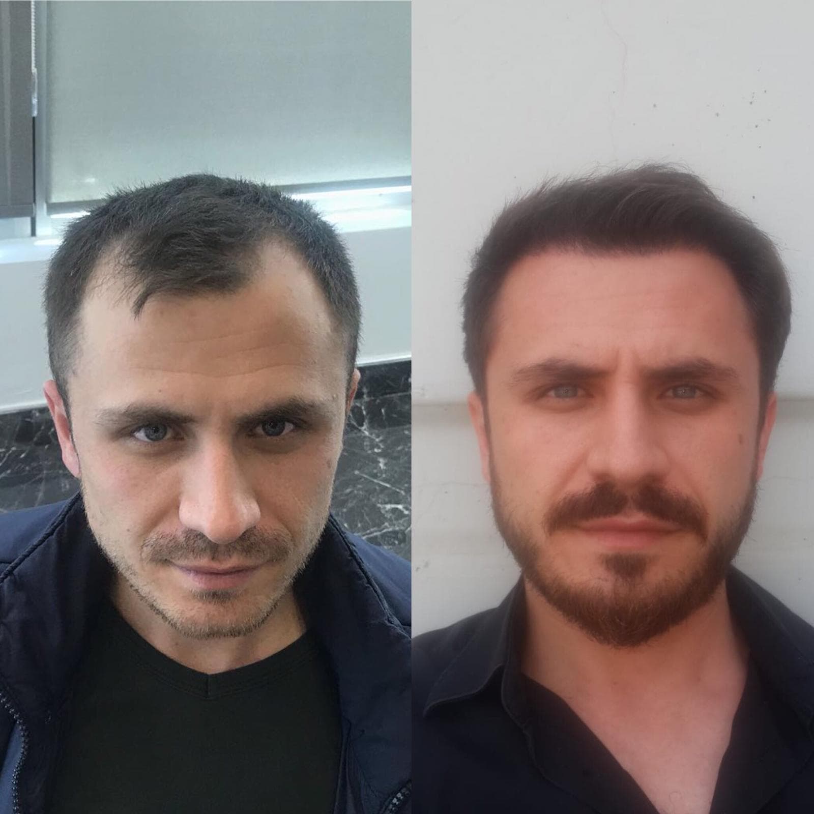 Hair transplant before and after — case 18