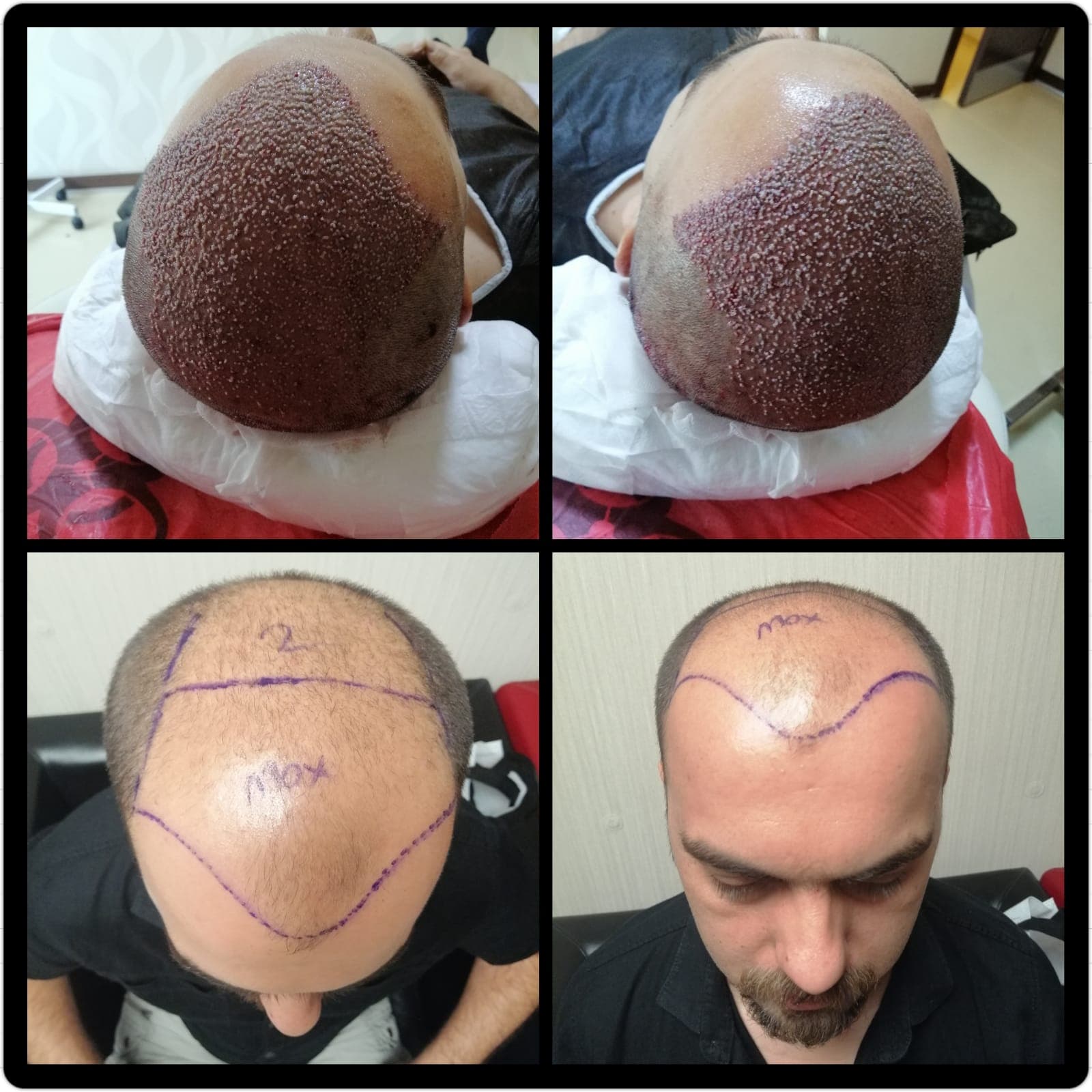 Hair transplant before and after — case 19
