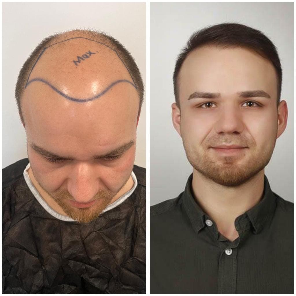 Hair transplant before and after — case 20