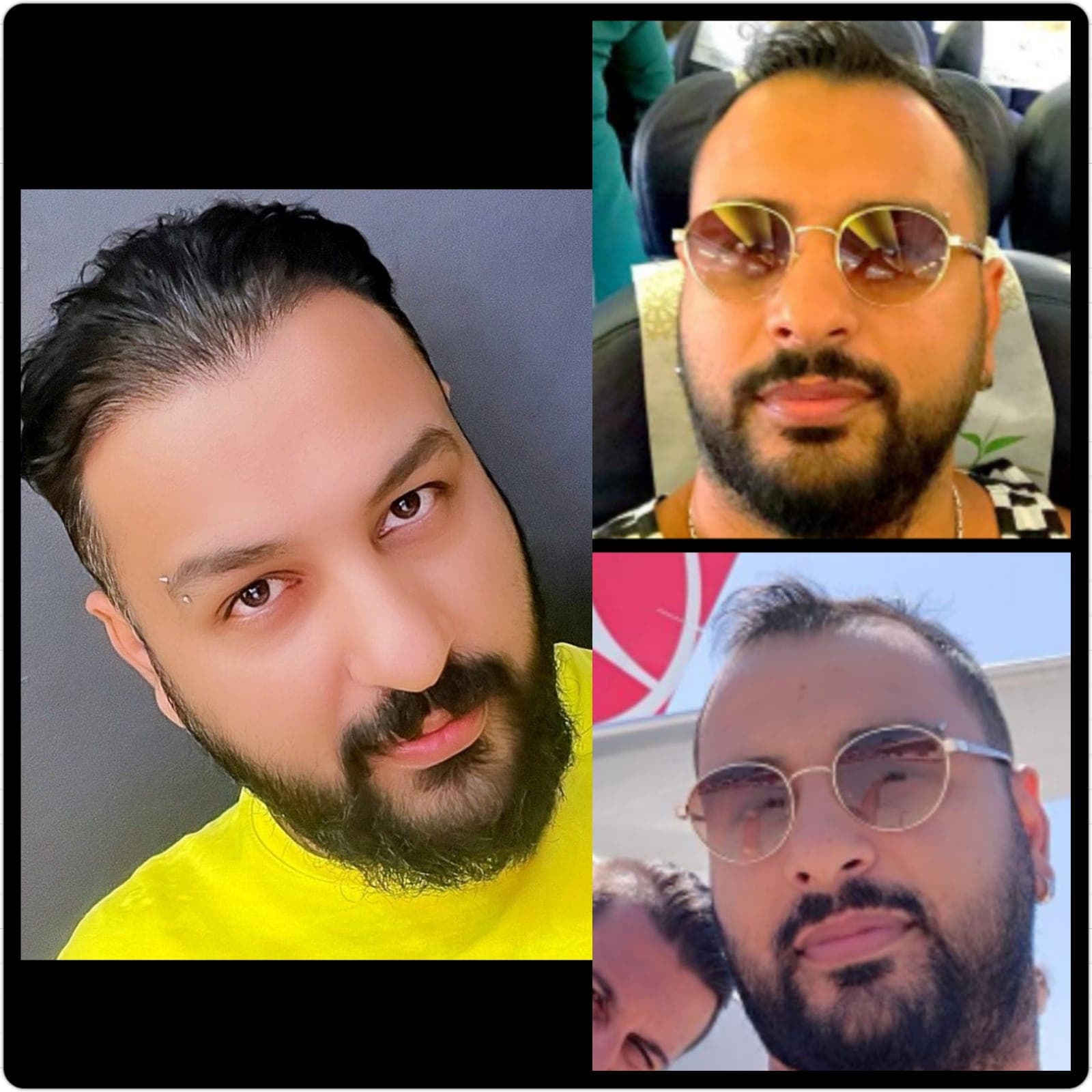 Hair transplant before and after — case 21