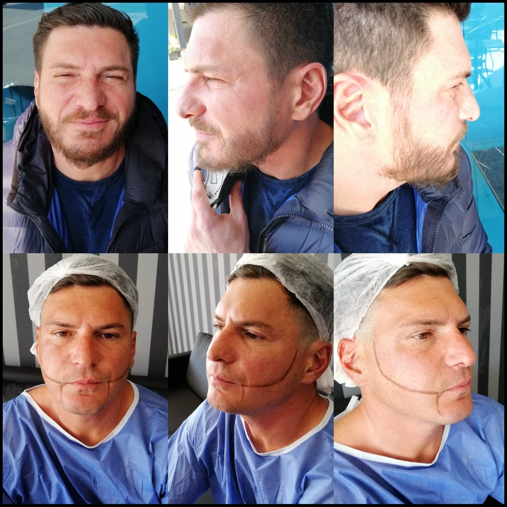 Hair transplant before and after — case 22