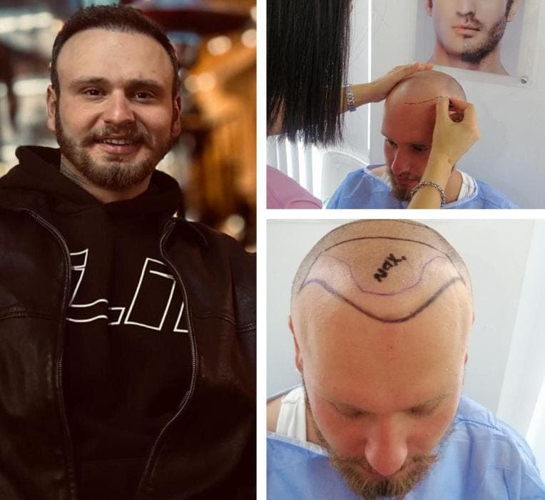 Hair transplant before and after — case 23