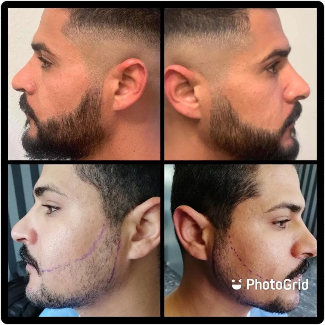 Hair transplant before and after — case 24