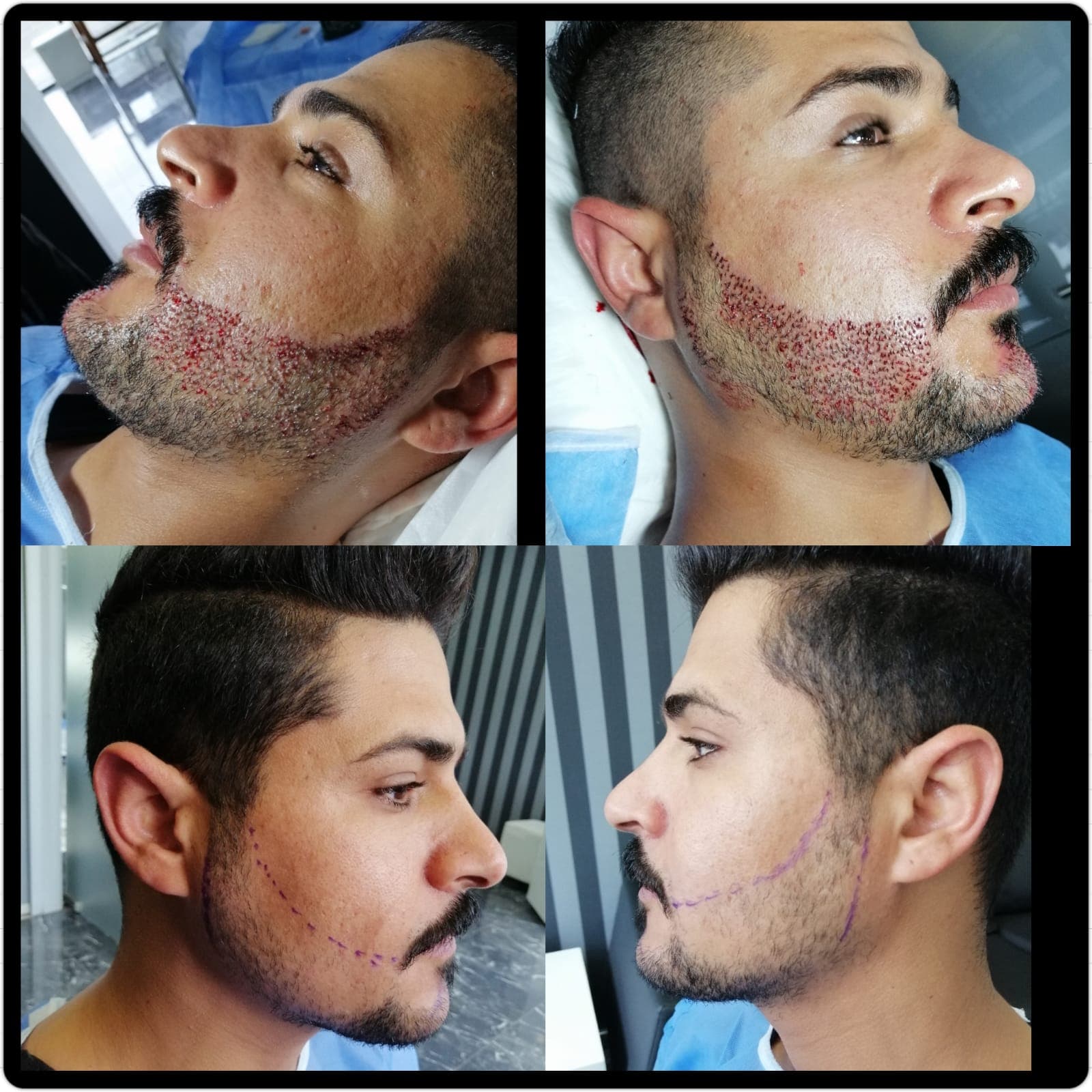 Hair transplant before and after — case 25