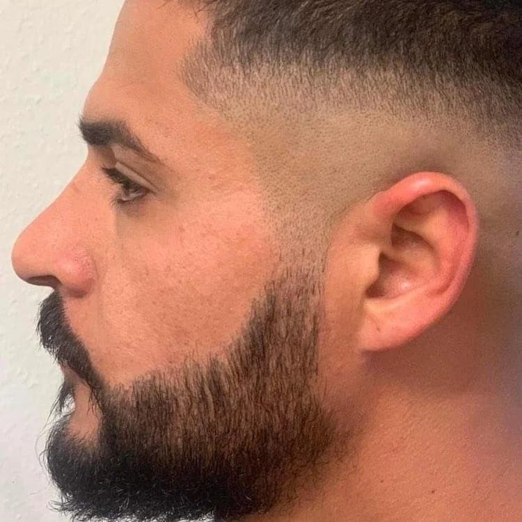 Hair transplant before and after — case 26