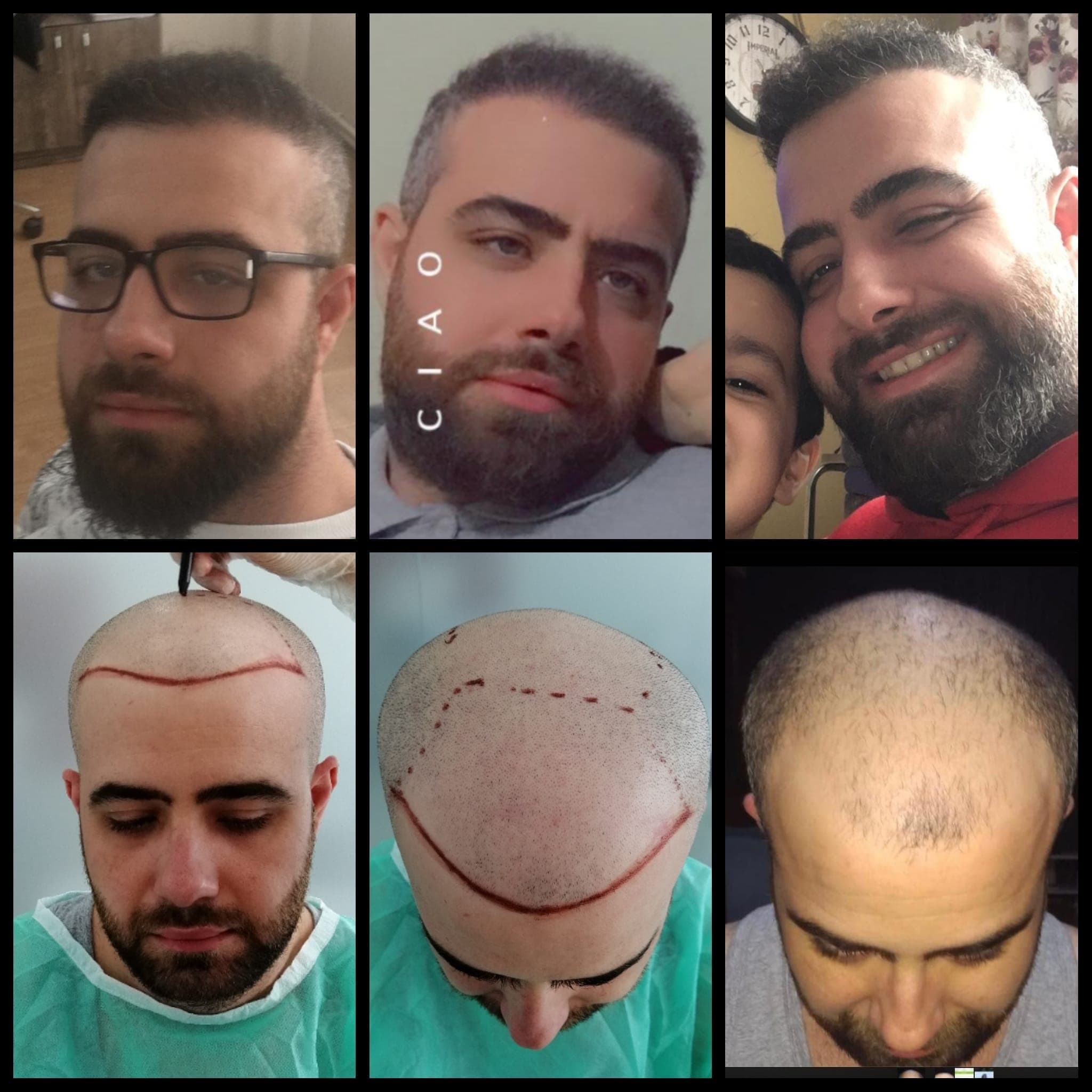 Hair transplant before and after — case 27