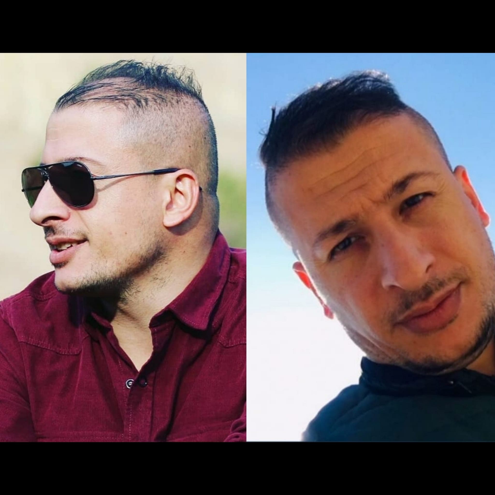 Hair transplant before and after — case 28