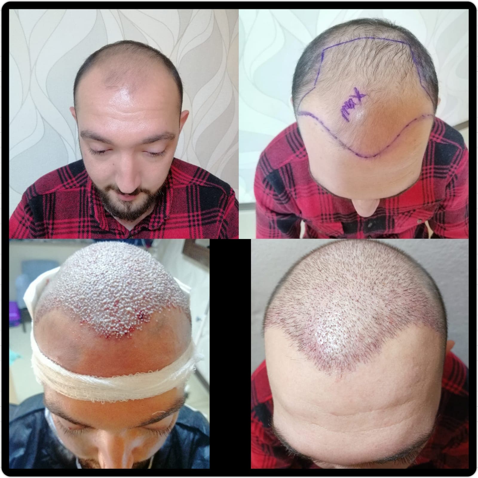 Hair transplant before and after — case 29