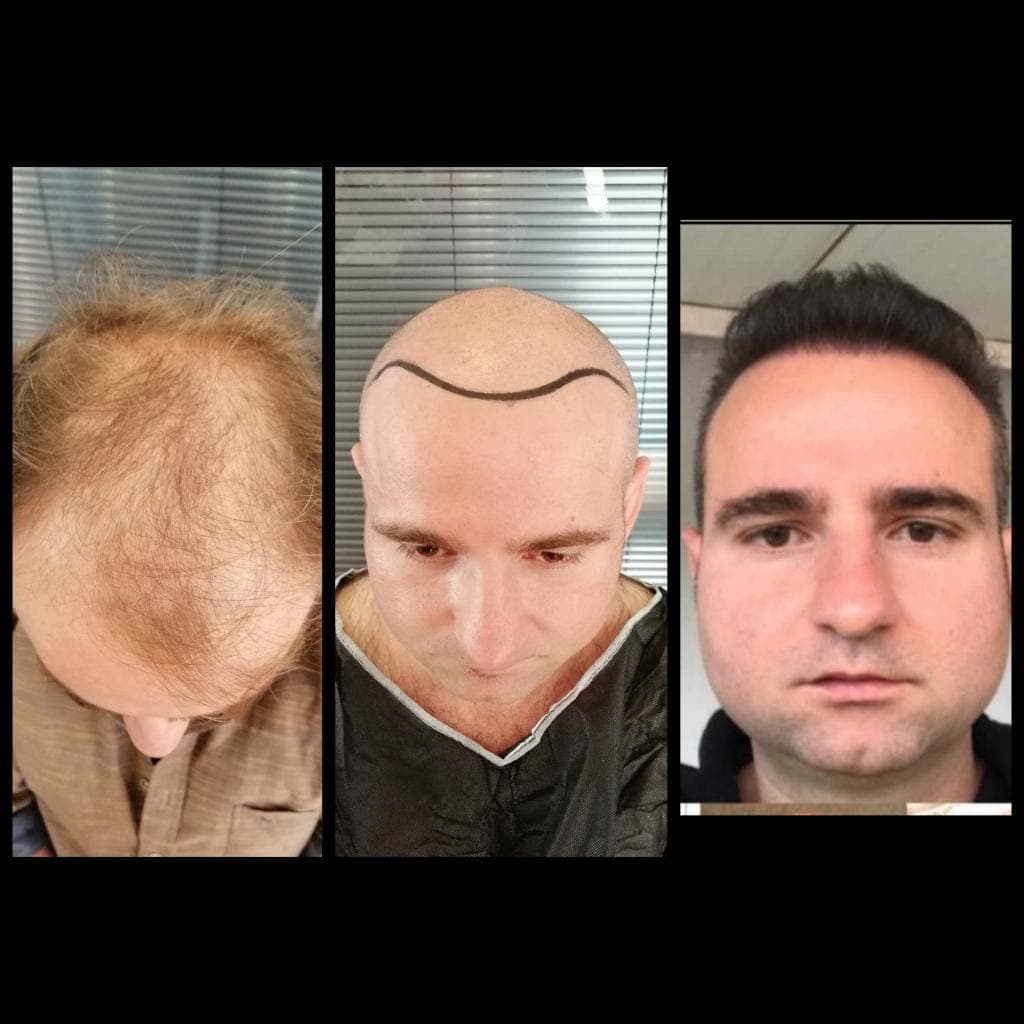 Hair transplant before and after — case 30
