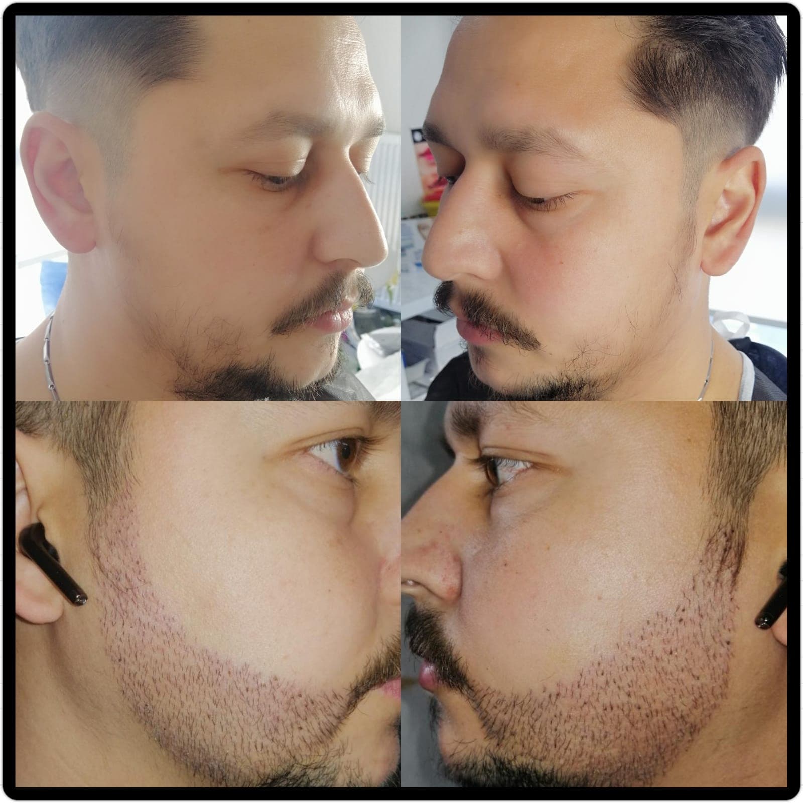 Hair transplant before and after — case 31