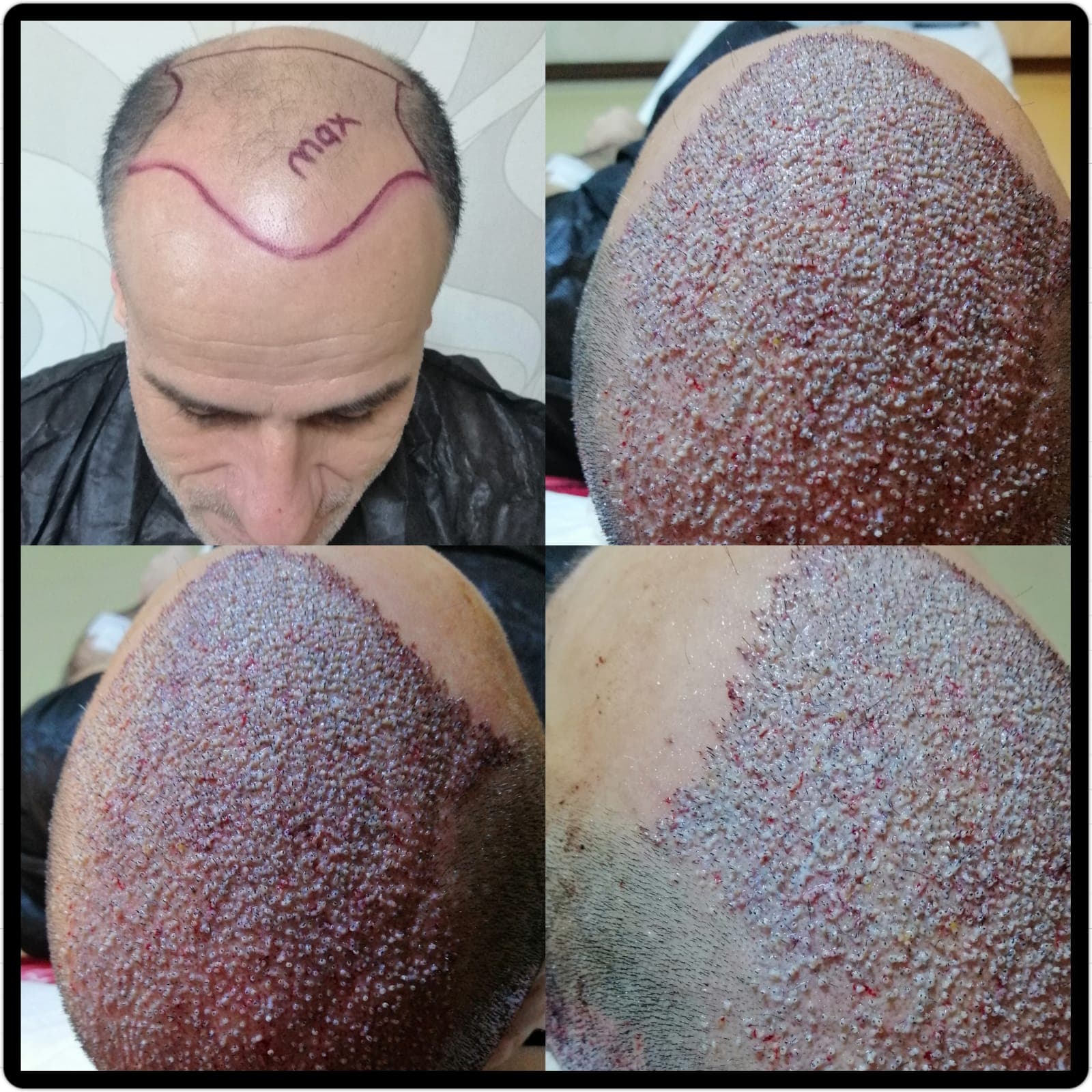 Hair transplant before and after — case 32
