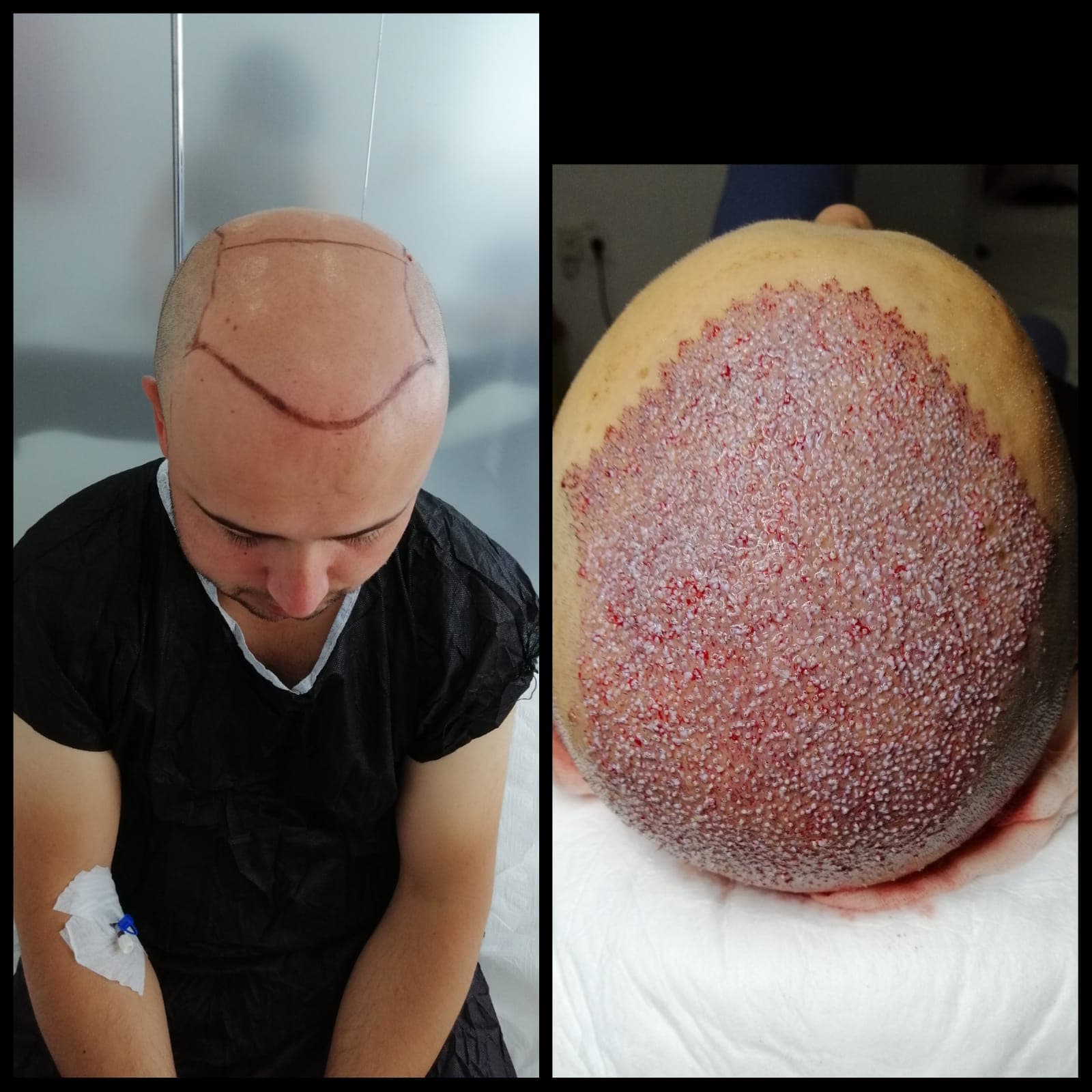 Hair transplant before and after — case 33