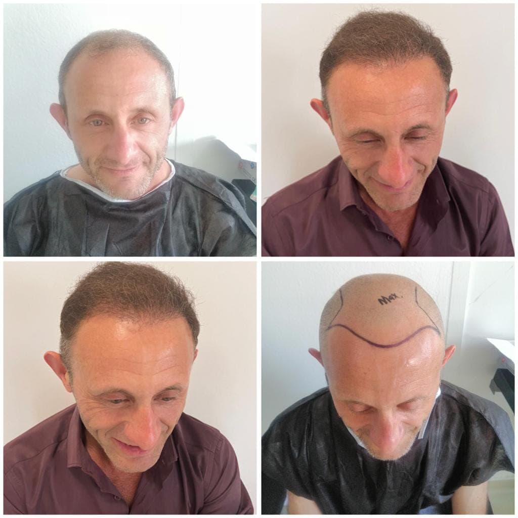 Hair transplant before and after — case 34