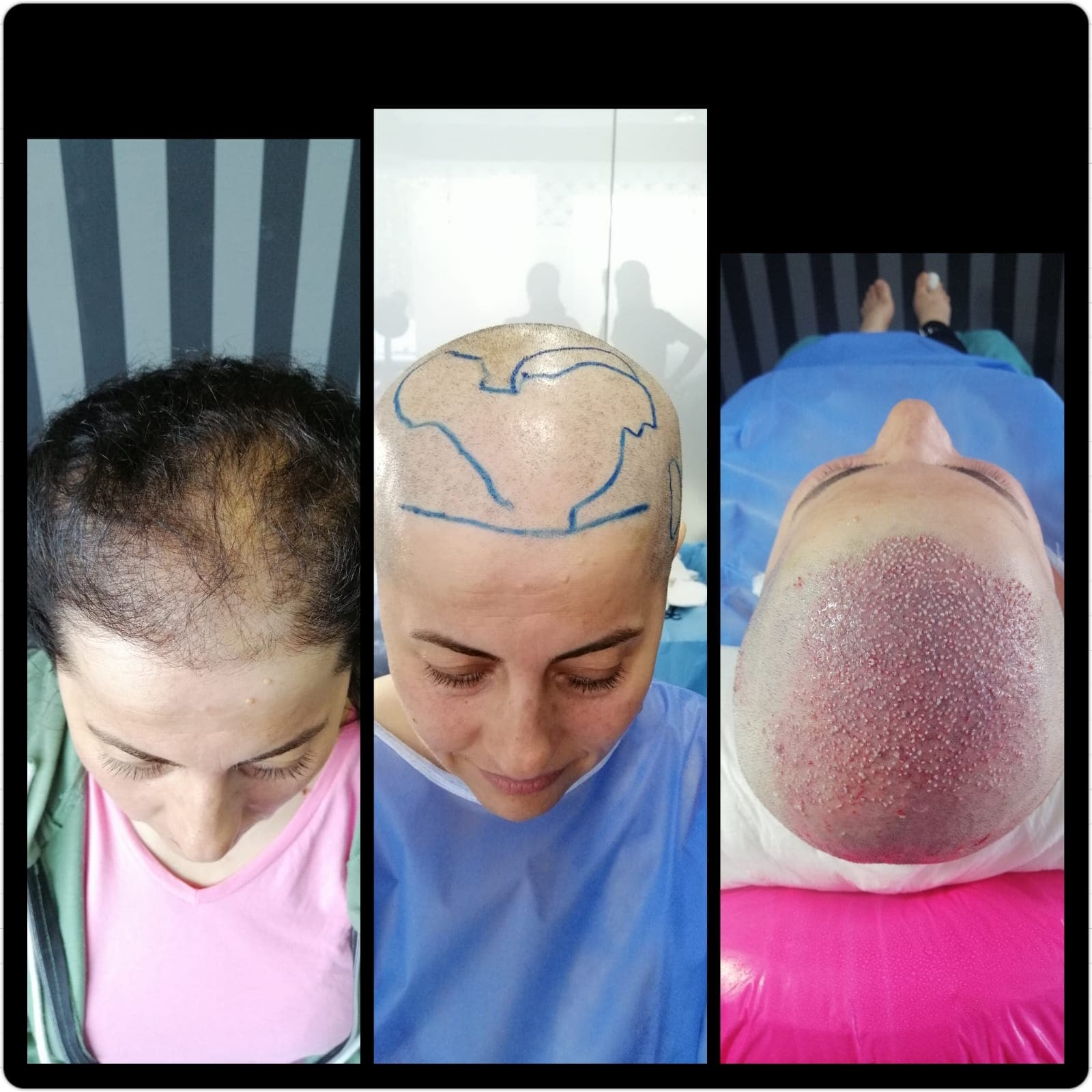 Hair transplant before and after — case 35