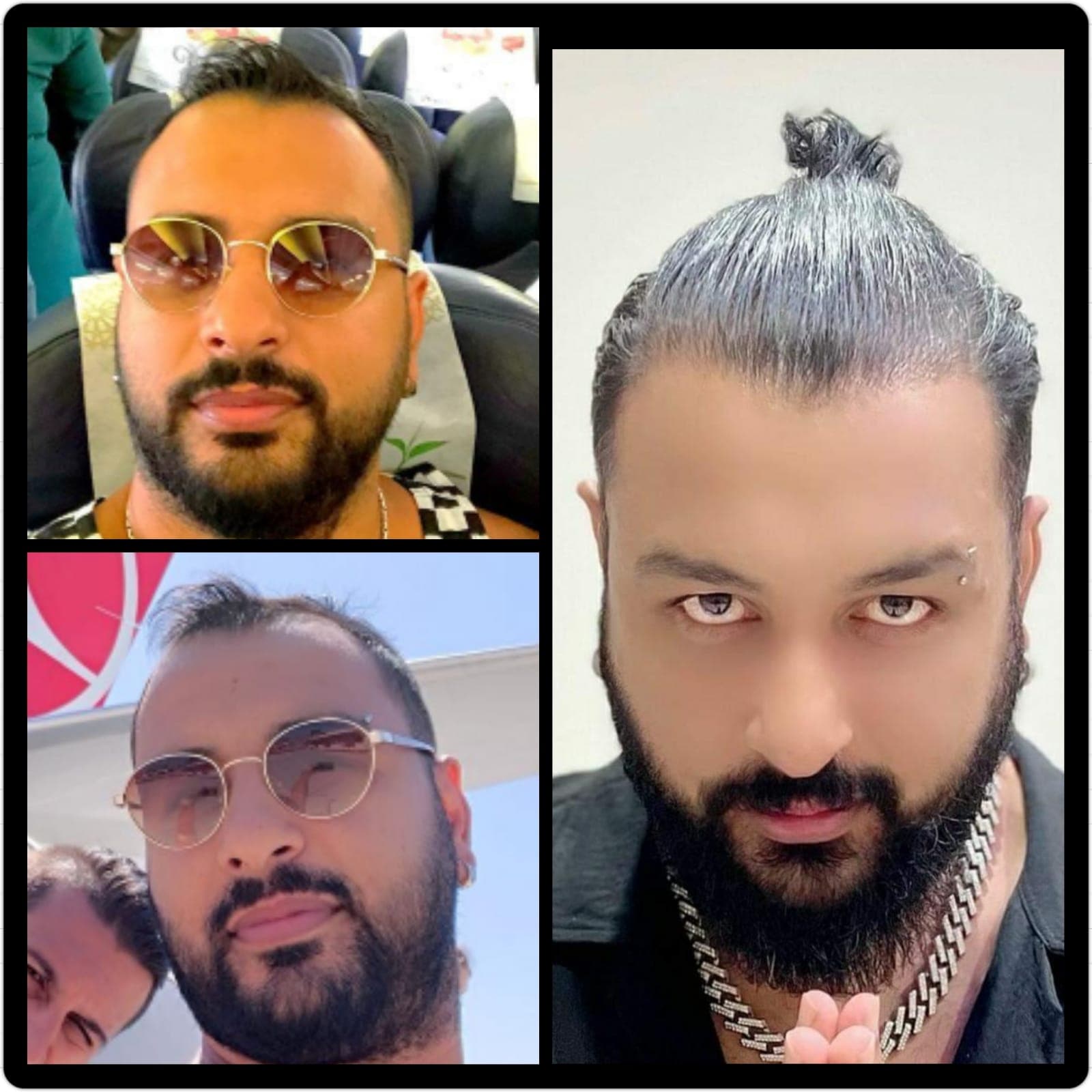 Hair transplant before and after — case 36