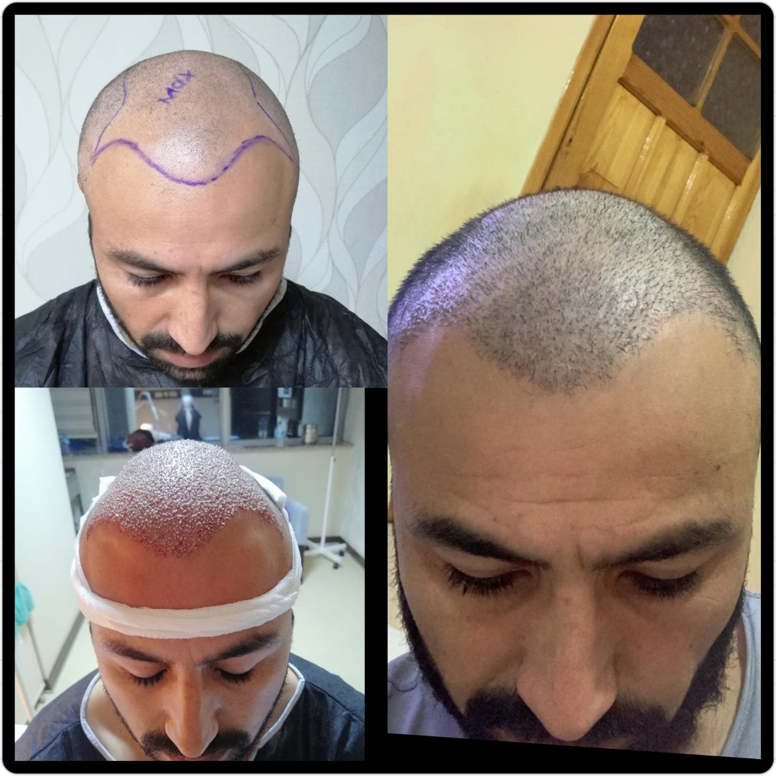Hair transplant before and after — case 37