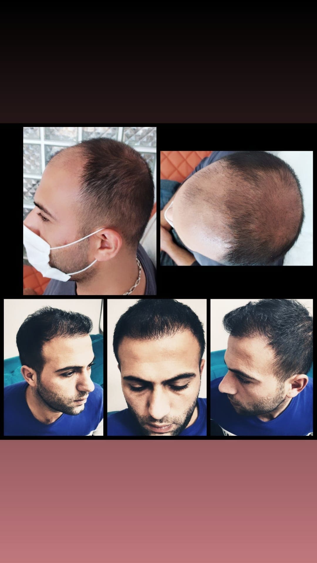 Hair transplant before and after — case 38