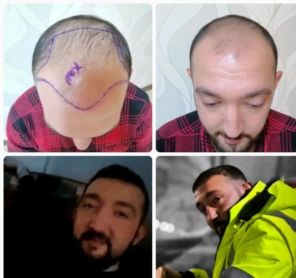 Hair transplant before and after — case 39