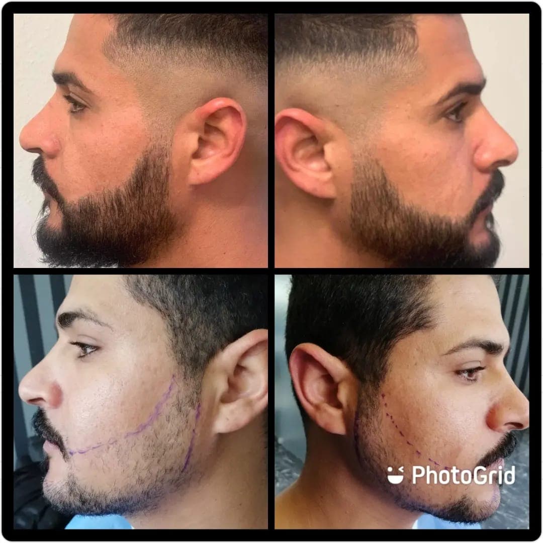 Hair transplant before and after — case 40
