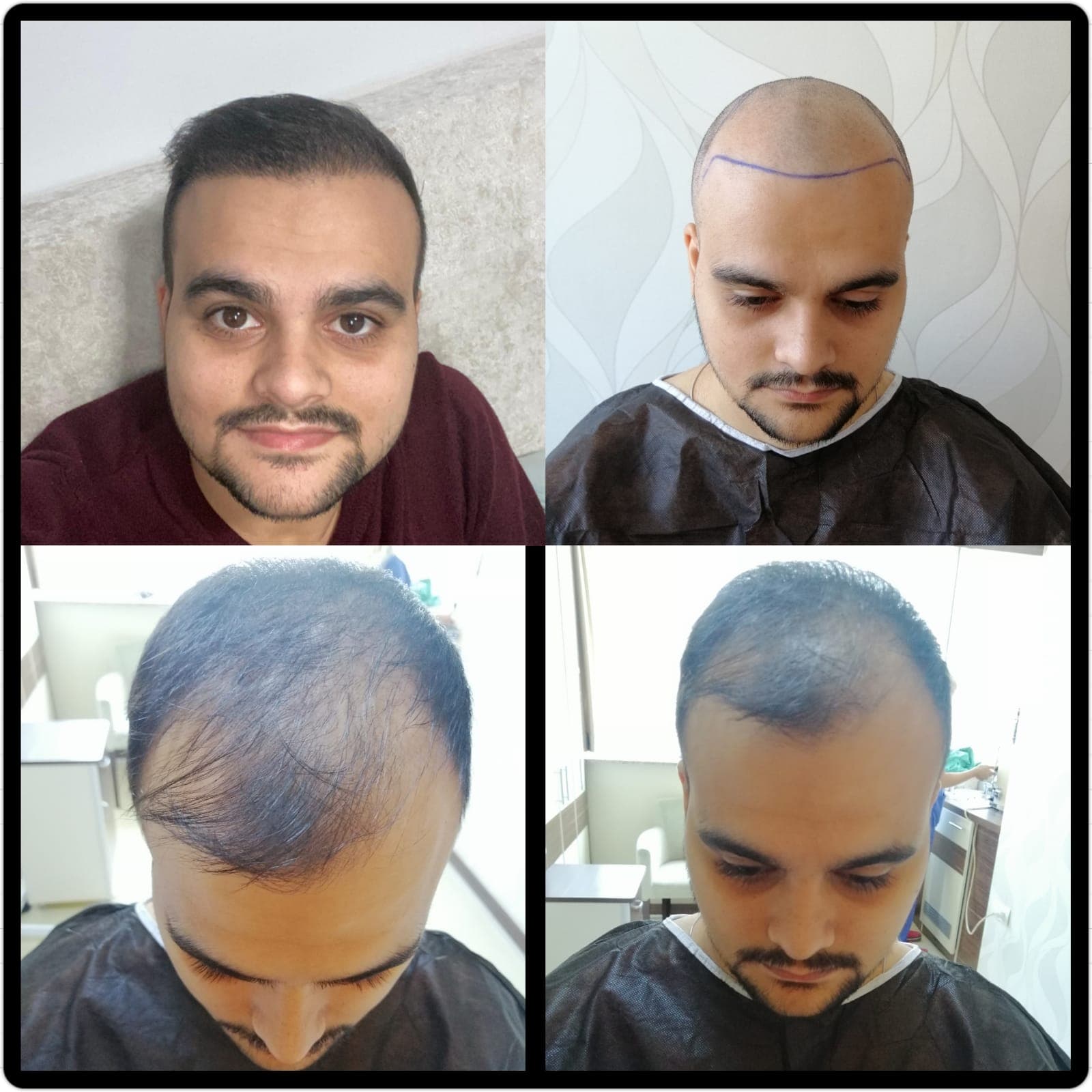 Hair transplant before and after — case 41