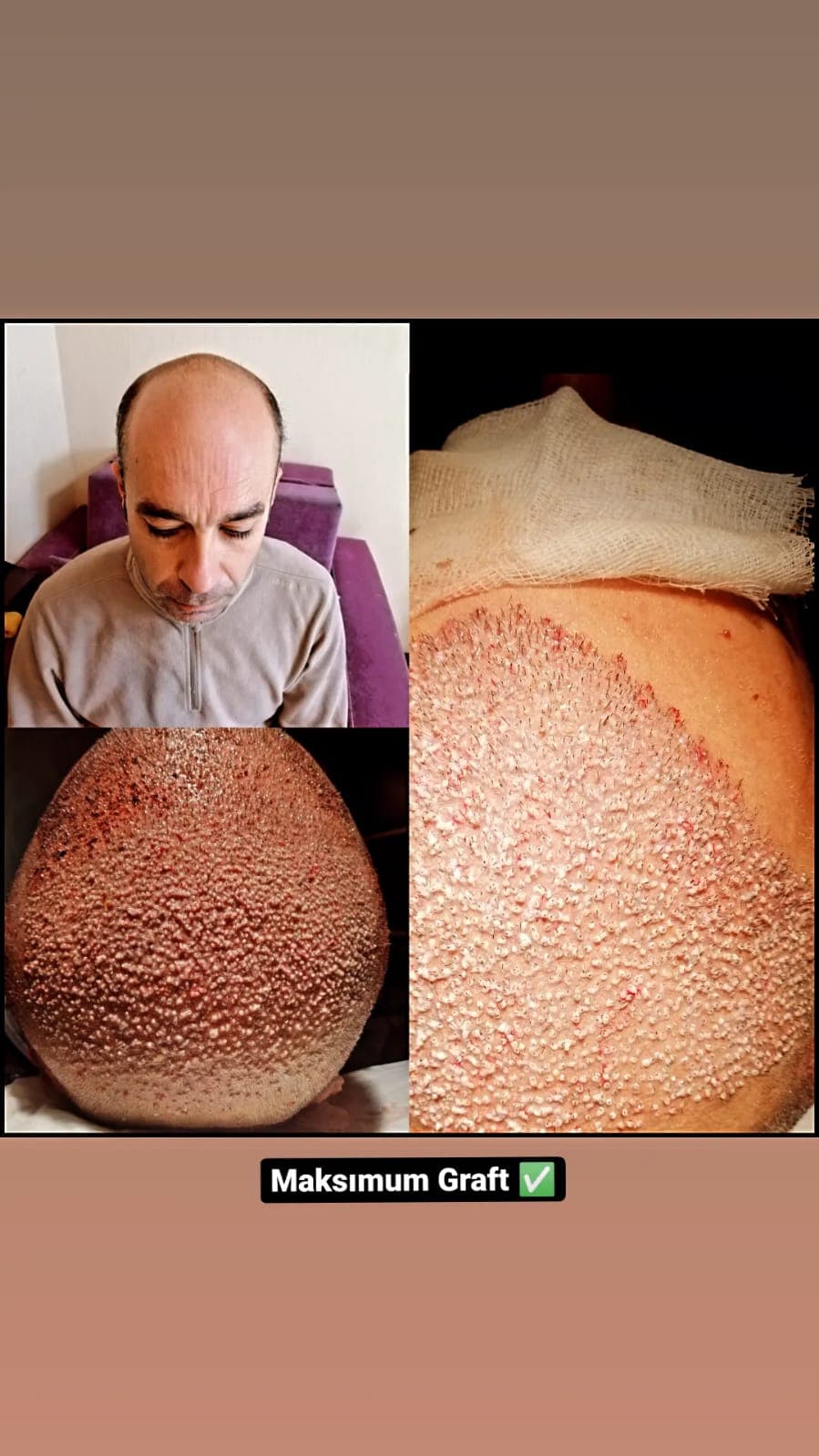 Hair transplant before and after — case 42
