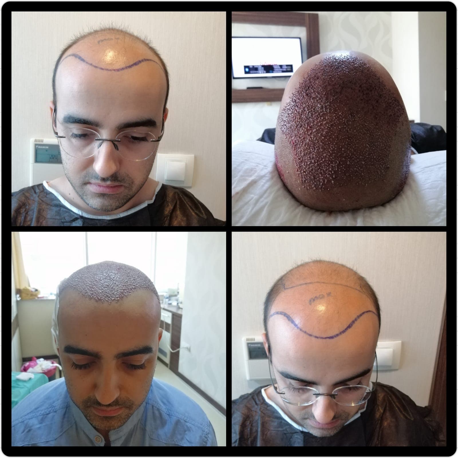 Hair transplant before and after — case 43