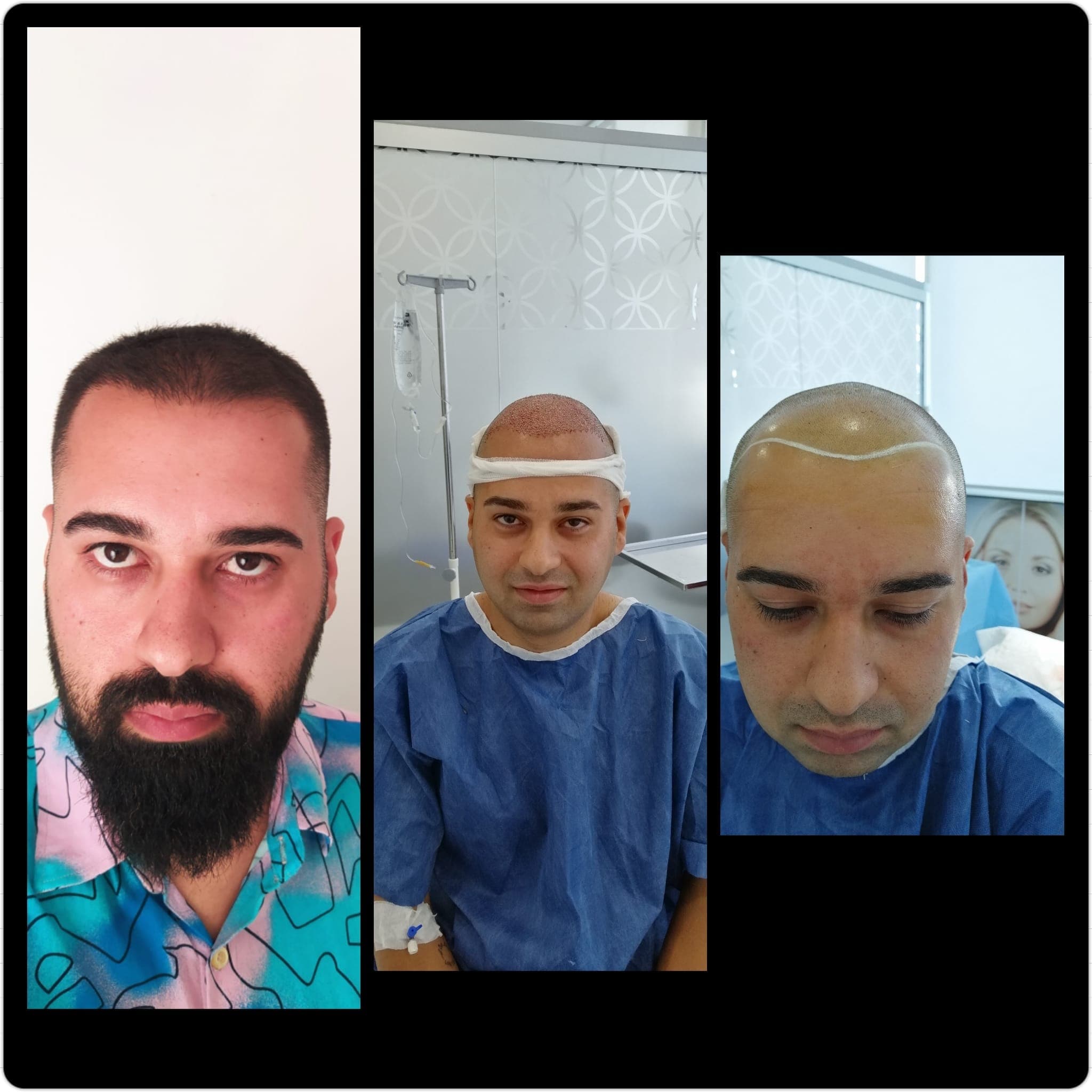 Hair transplant before and after — case 44