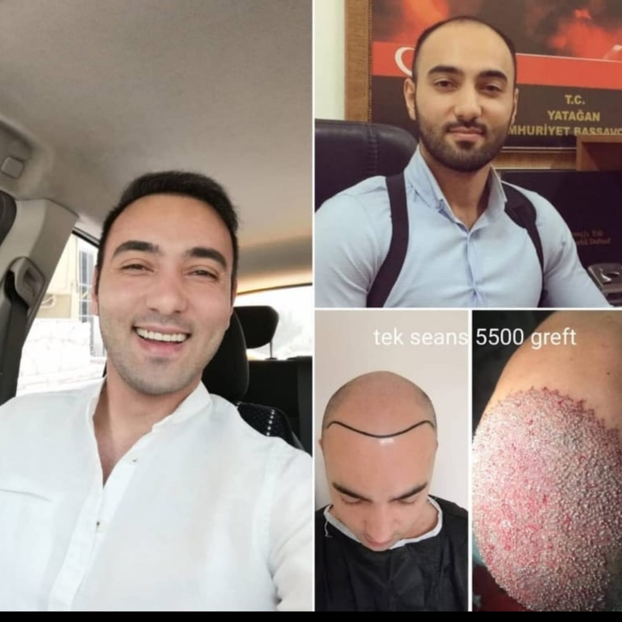 Hair transplant before and after — case 45