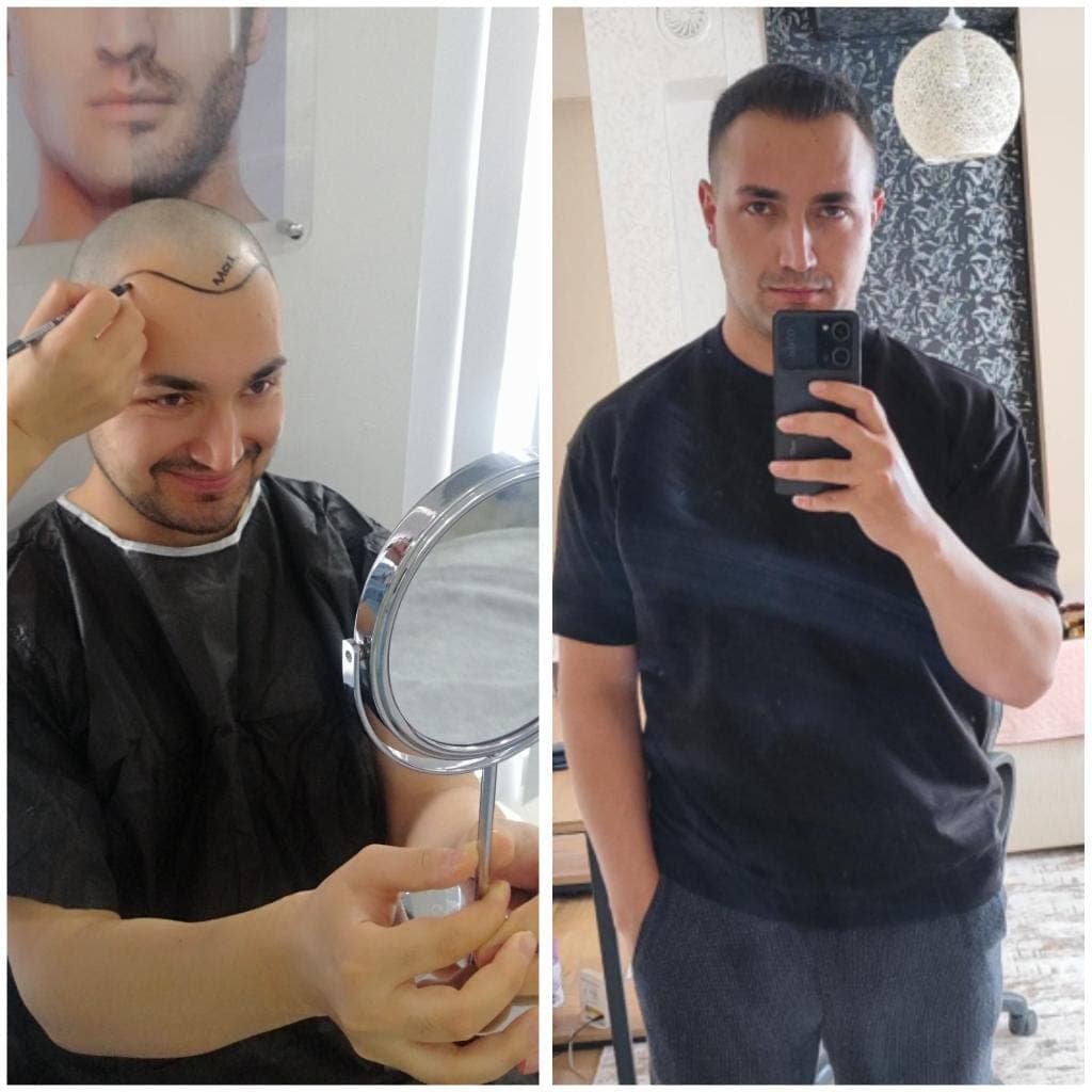 Hair transplant before and after — case 46