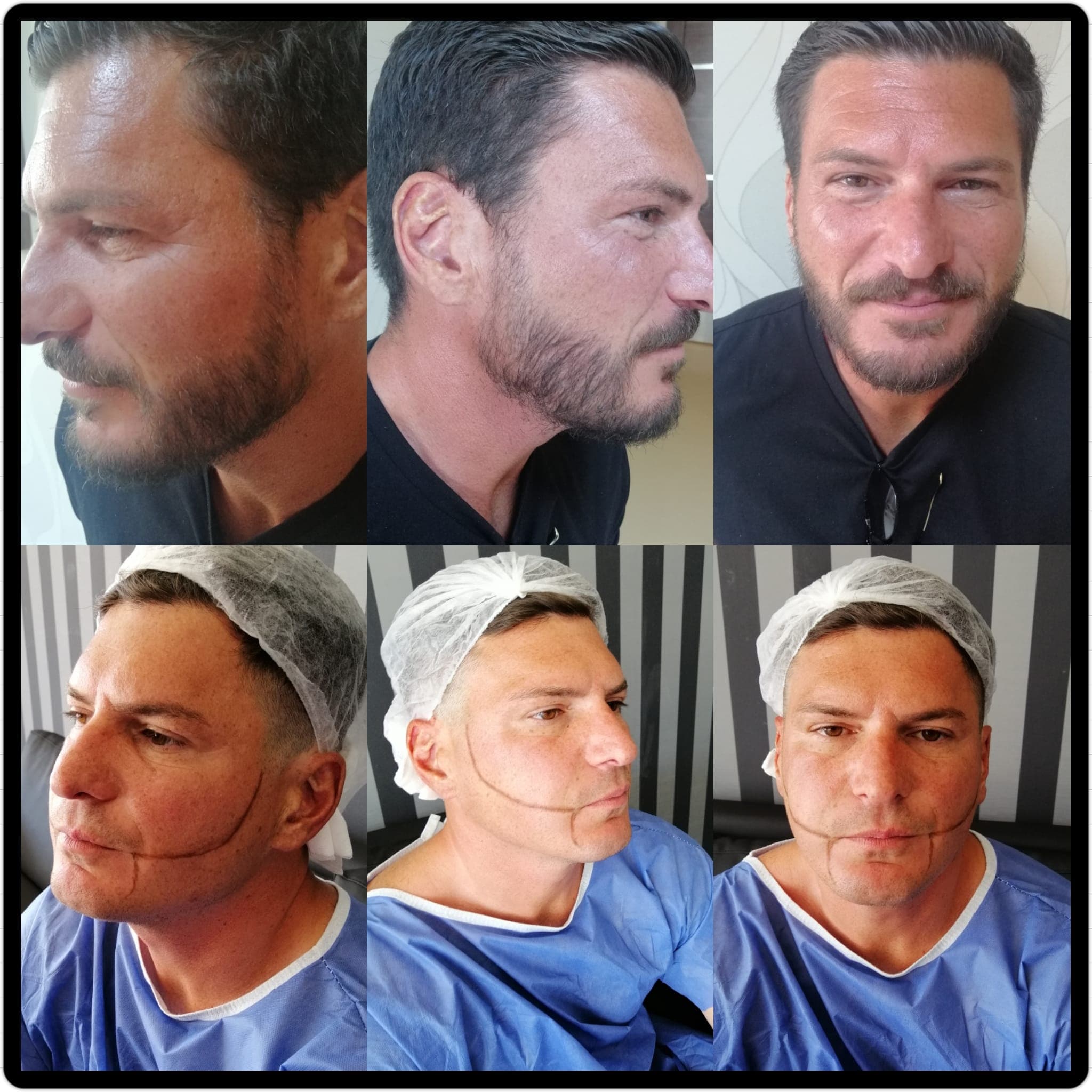 Hair transplant before and after — case 47