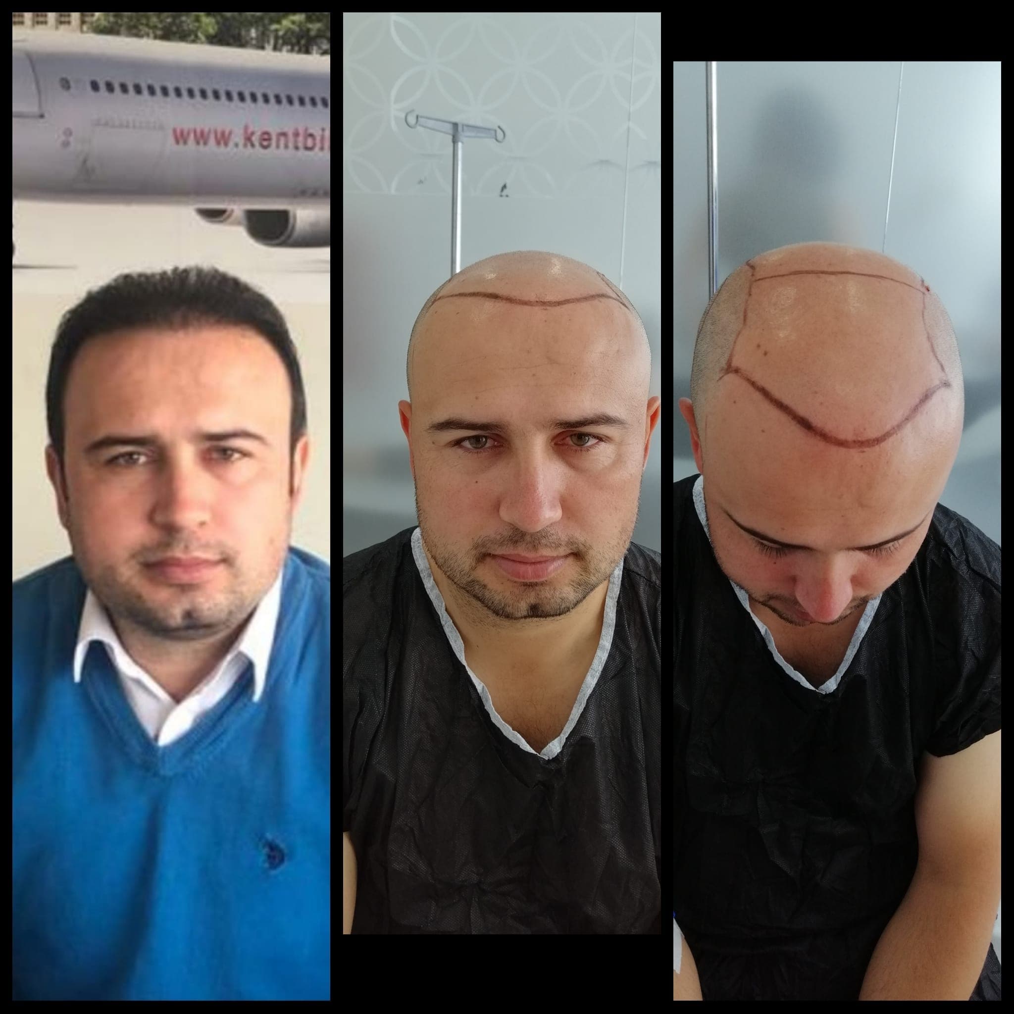 Hair transplant before and after — case 48