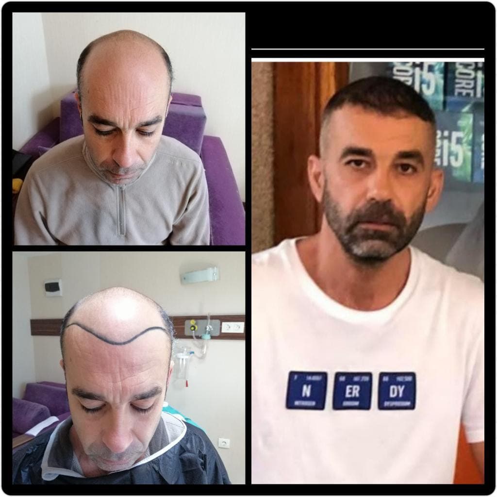 Hair transplant before and after — case 49