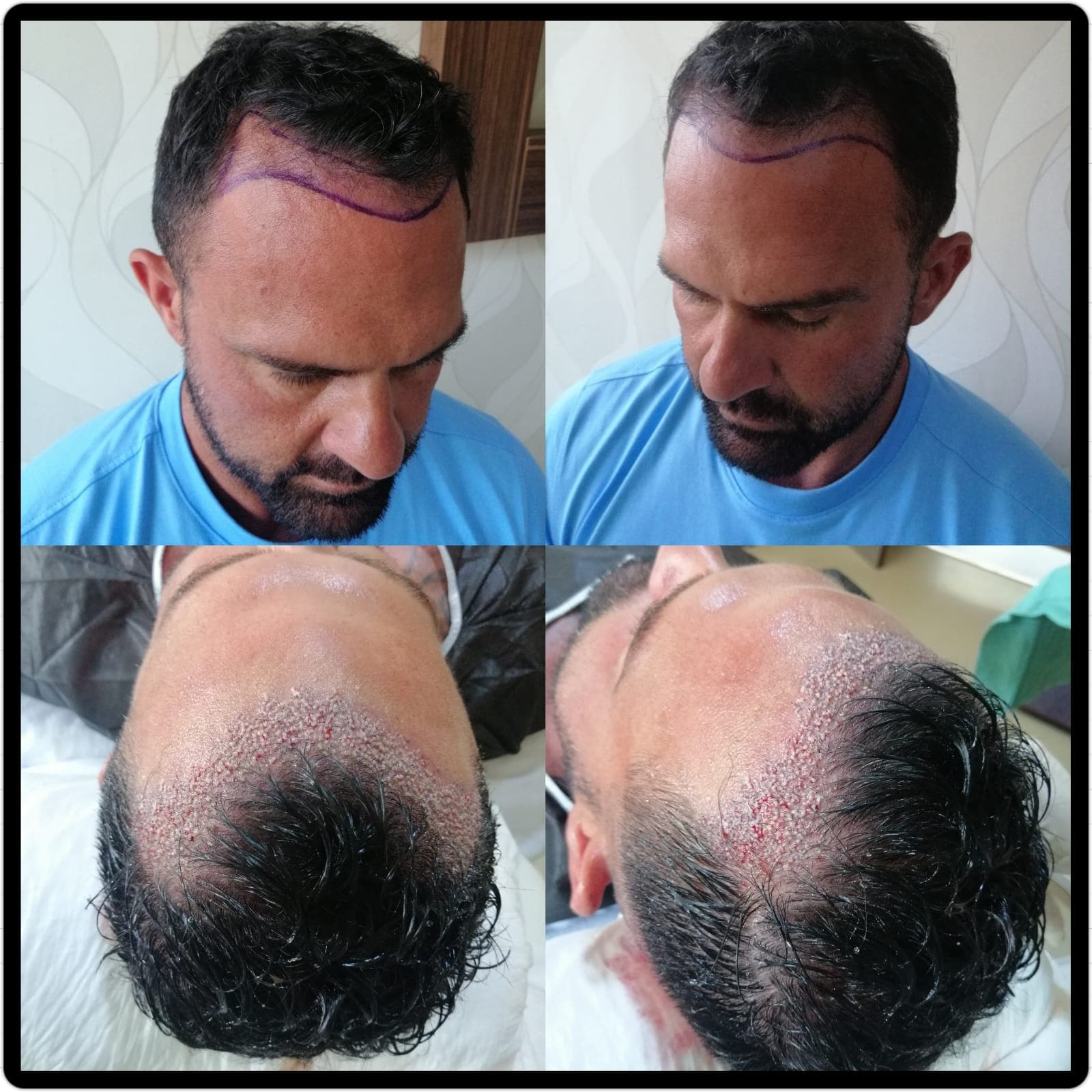 Hair transplant before and after — case 50