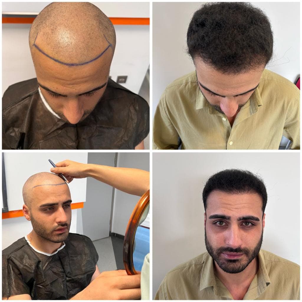 Hair transplant before and after — case 51