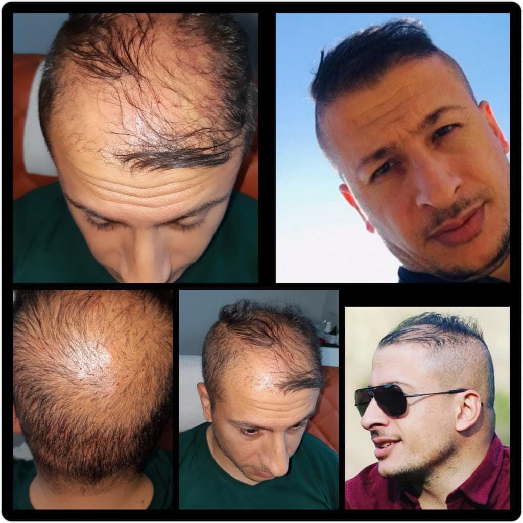 Hair transplant before and after — case 52