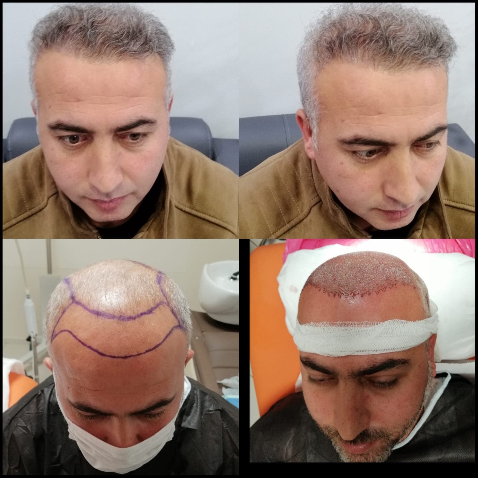 Hair transplant before and after — case 53