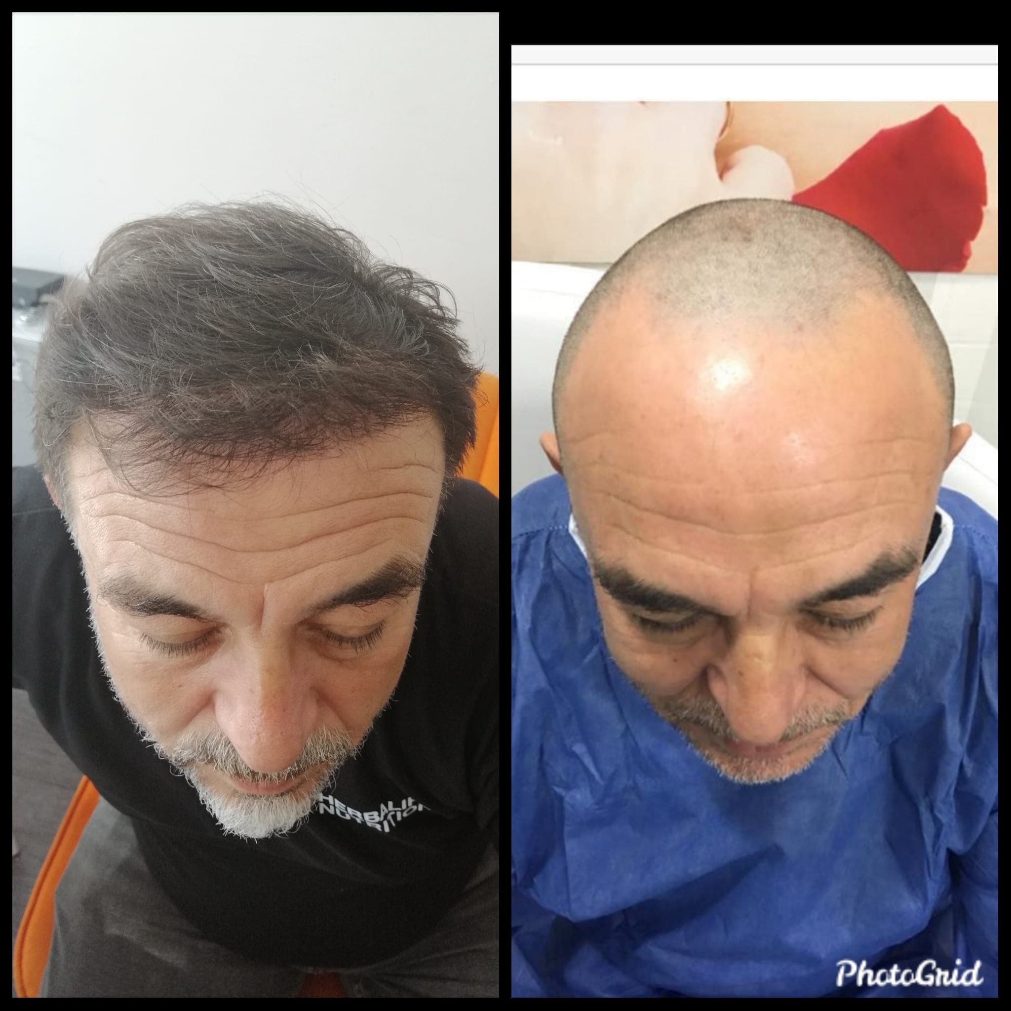 Hair transplant before and after — case 54