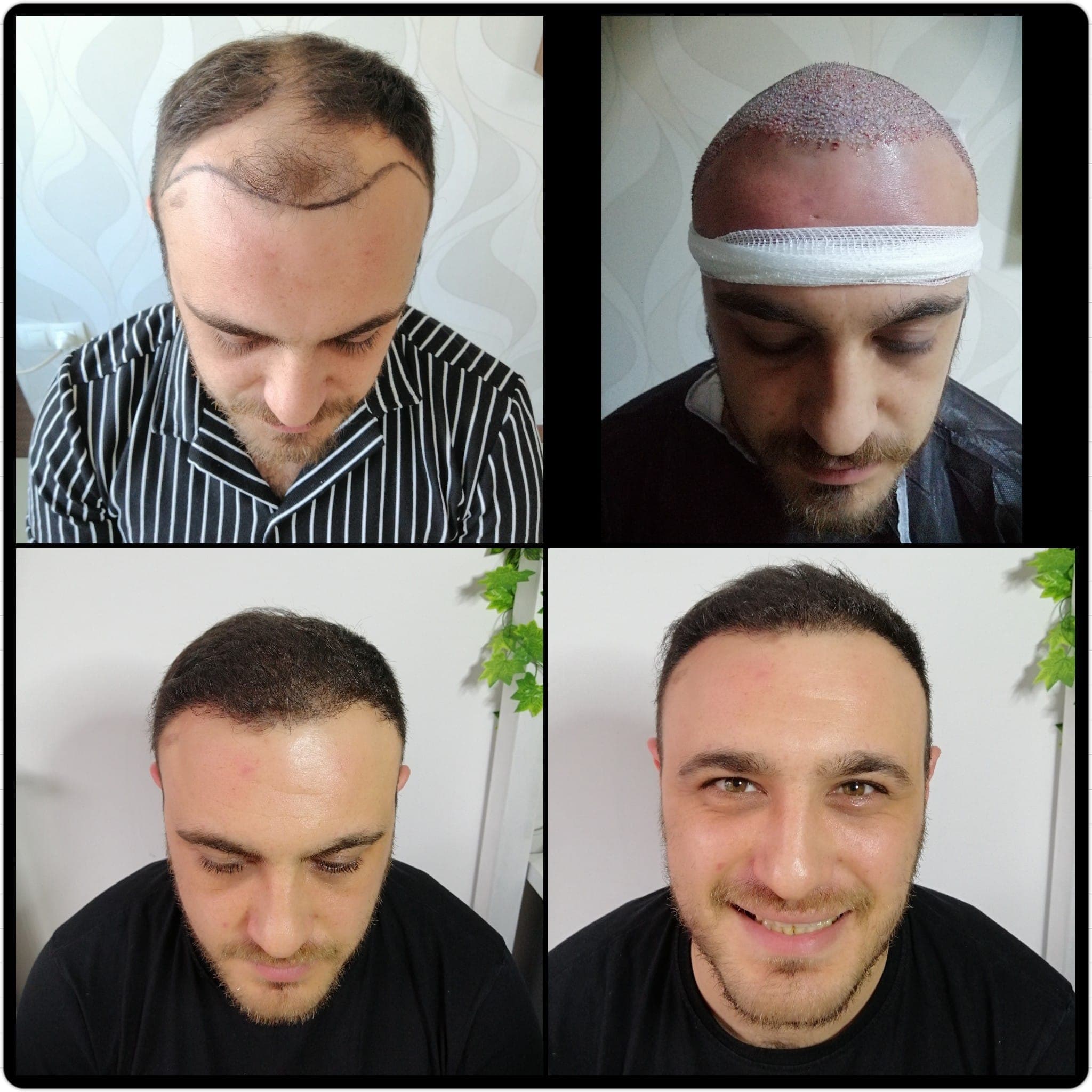 Hair transplant before and after — case 55
