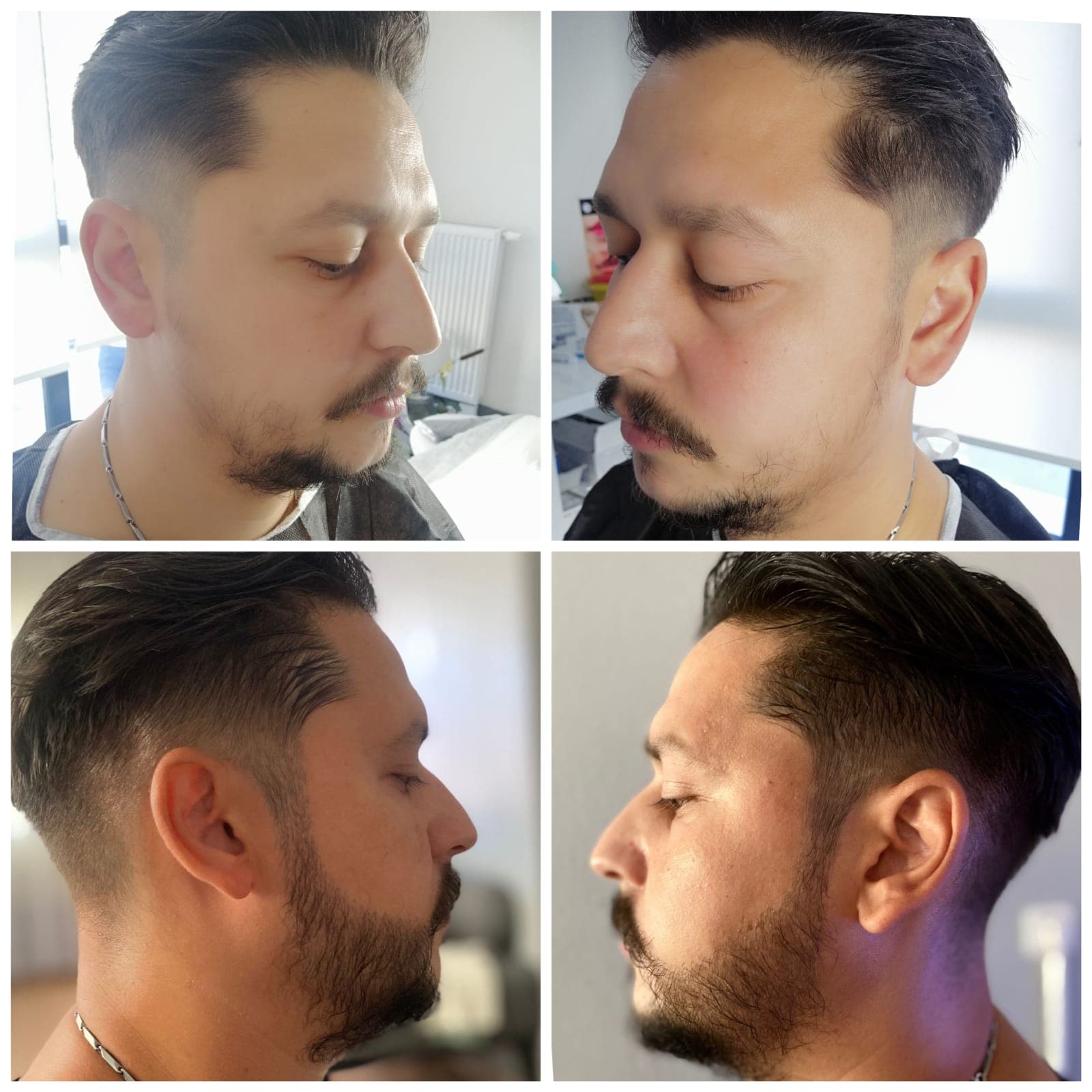 Hair transplant before and after — case 56