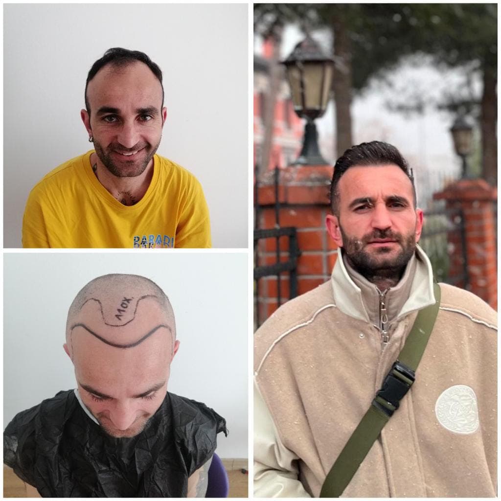 Hair transplant before and after — case 57